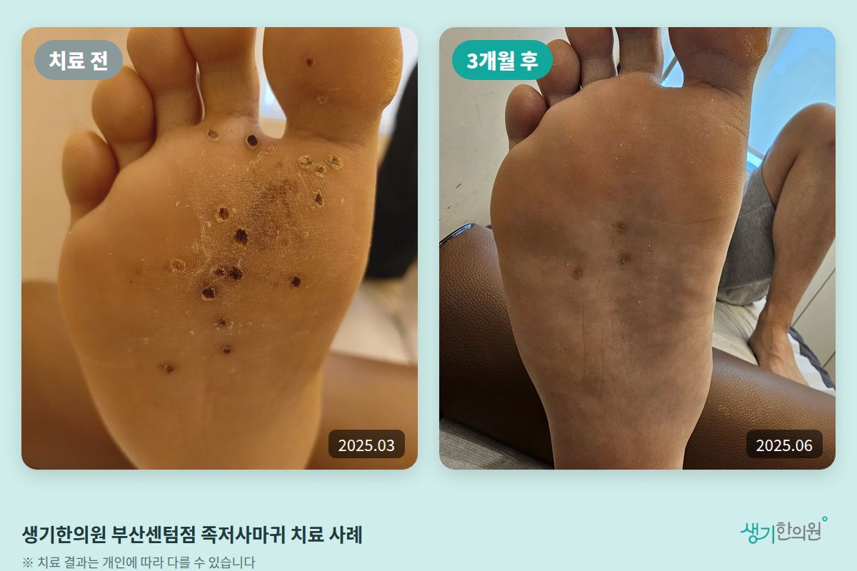 생기한의원 부산센텀점 족저사마귀 치료 전(2025.03)과 3개월 후(2025.06) 비교 사진