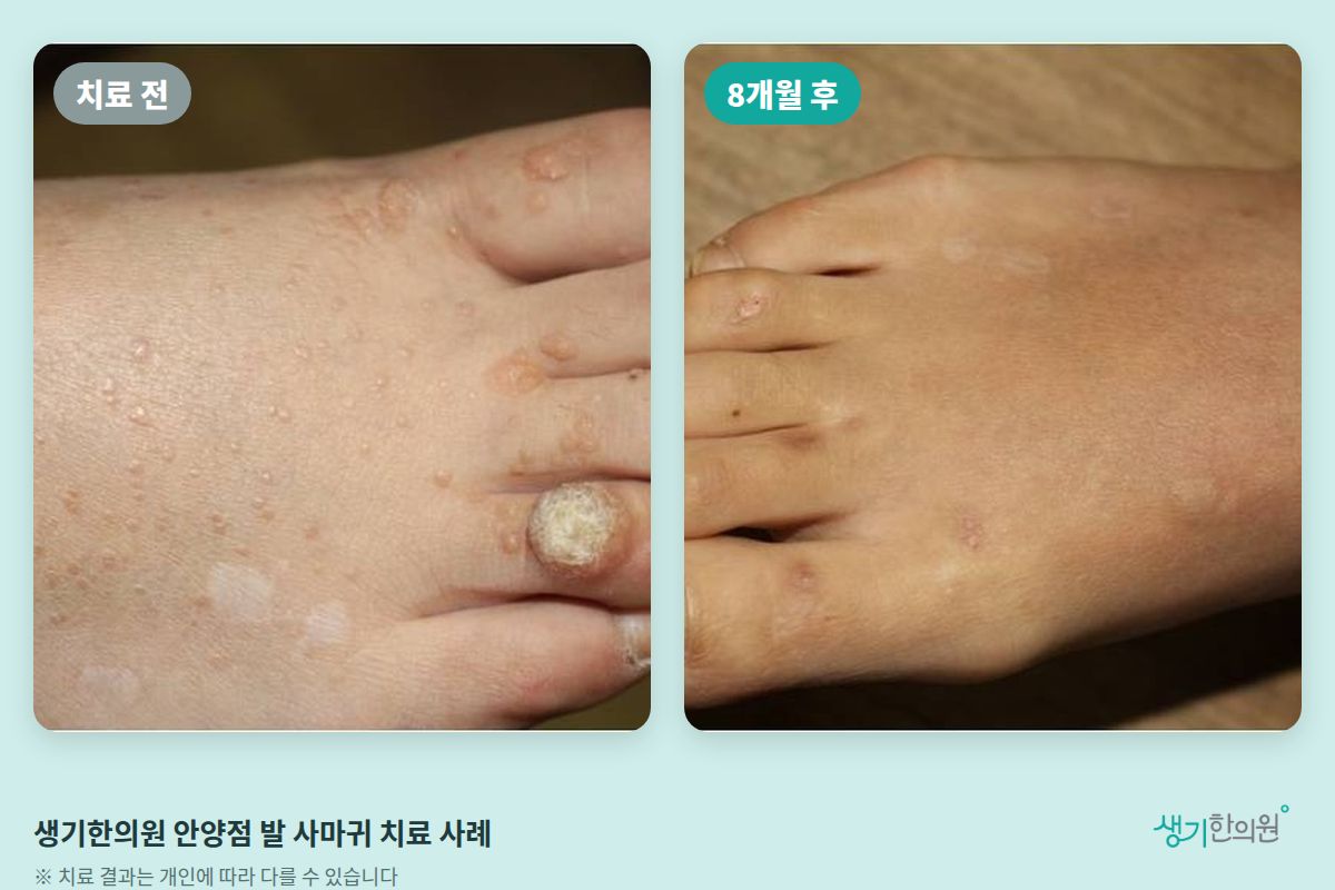 생기한의원 안양점 발 사마귀 치료 전과 8개월 후 비교 사진