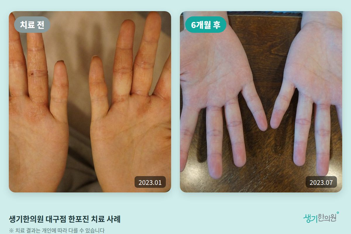 생기한의원 대구점 한포진 치료 전(2023.01)과 6개월 후(2023.07) 비교 사진
