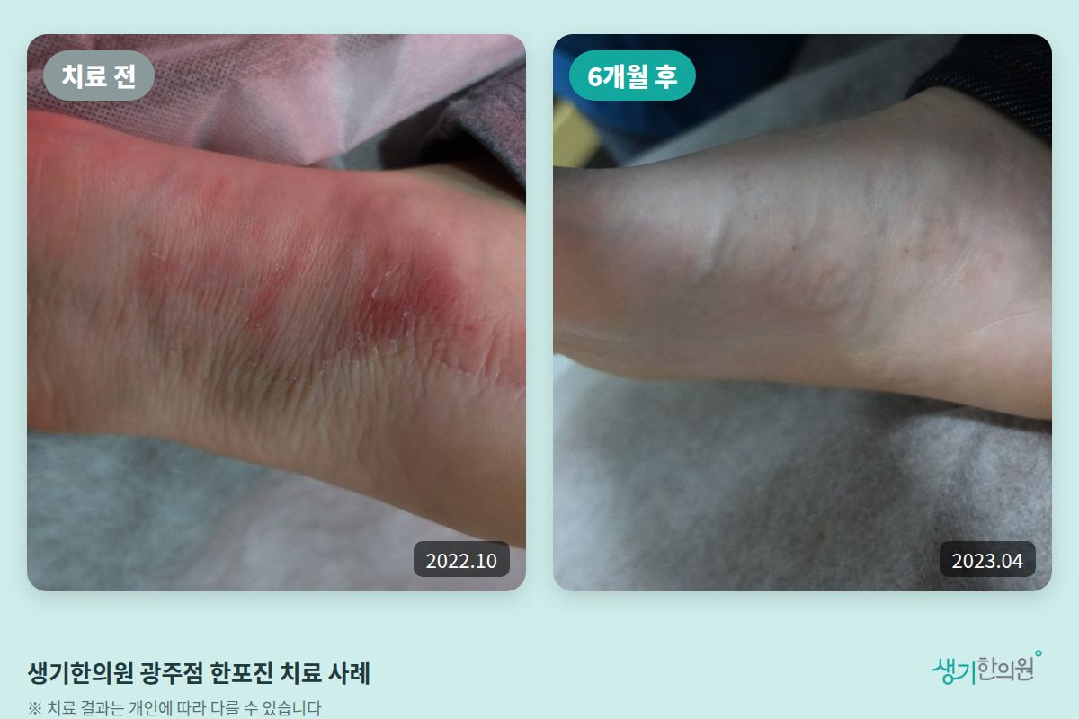 생기한의원 광주점 한포진 치료 전(2022.10)과 6개월 후(2023.04) 비교 사진