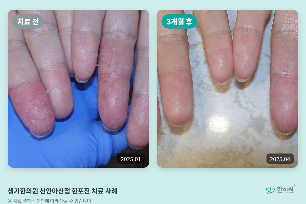생기한의원 천안아산점 한포진 치료 전(2025.01)과 3개월 후(2025.04) 비교 사진