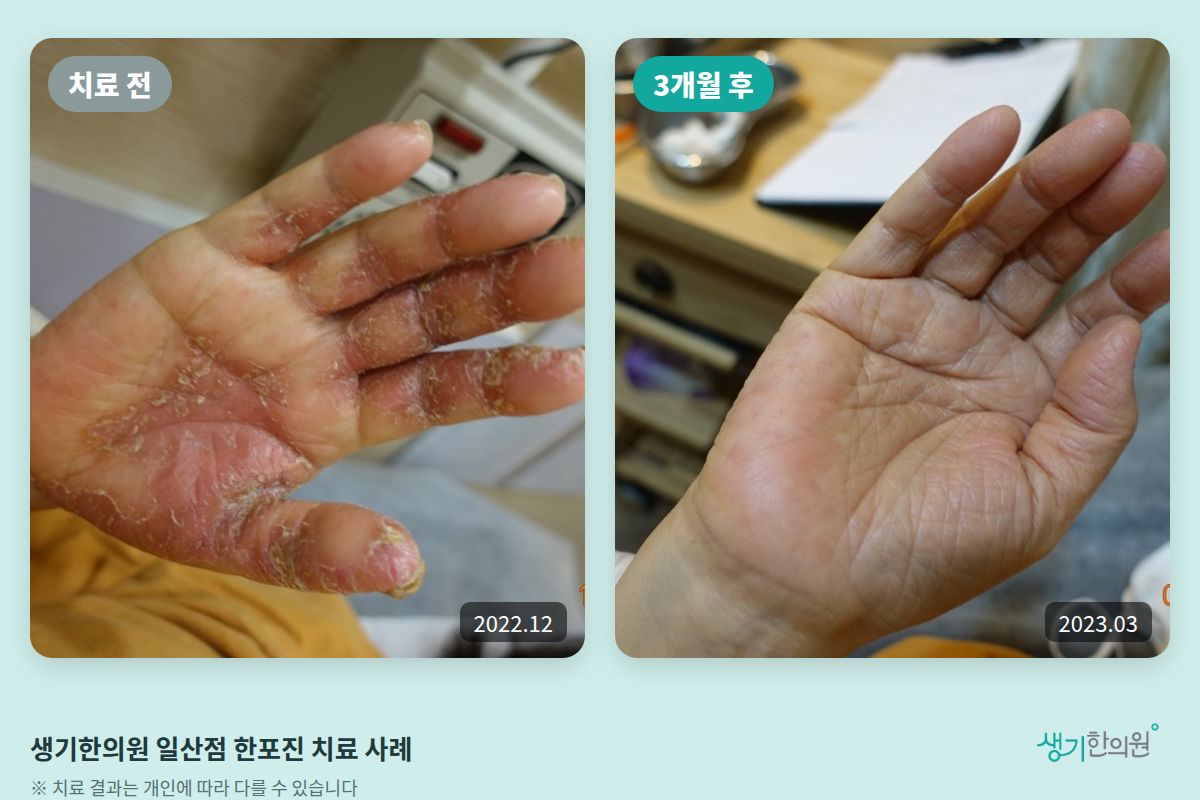 생기한의원 일산점 한포진 치료 전(2022.12)과 3개월 후(2023.03) 비교 사진
