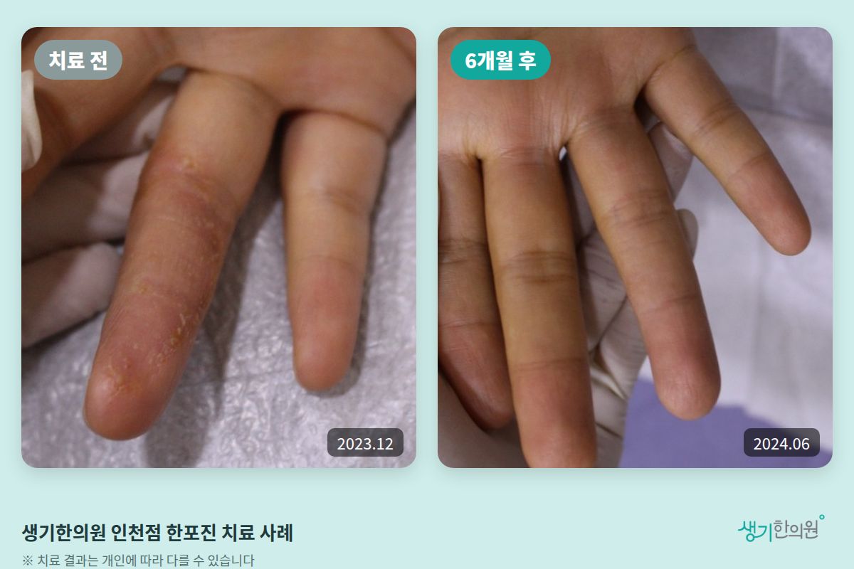 생기한의원 인천점 한포진 치료 전(2023.12)과 6개월 후(2024.06) 비교 사진