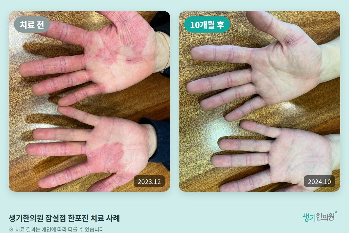 생기한의원 잠실점 한포진 치료 전(2023.12)과 10개월 후(2024.10) 비교 사진
