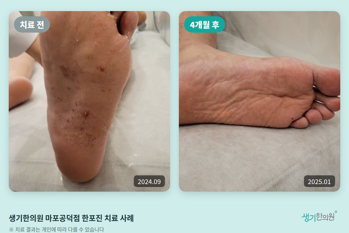 생기한의원 마포공덕점 한포진 치료 전(2024.09)과 4개월 후(2025.01) 비교 사진
