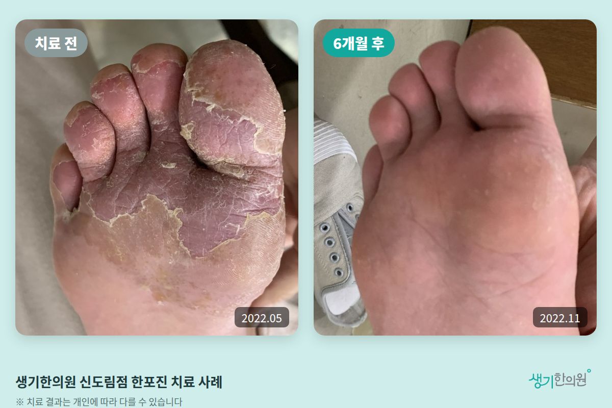 생기한의원 신도림점 한포진 치료 전(2022.05)과 6개월 후(2022.11) 비교 사진