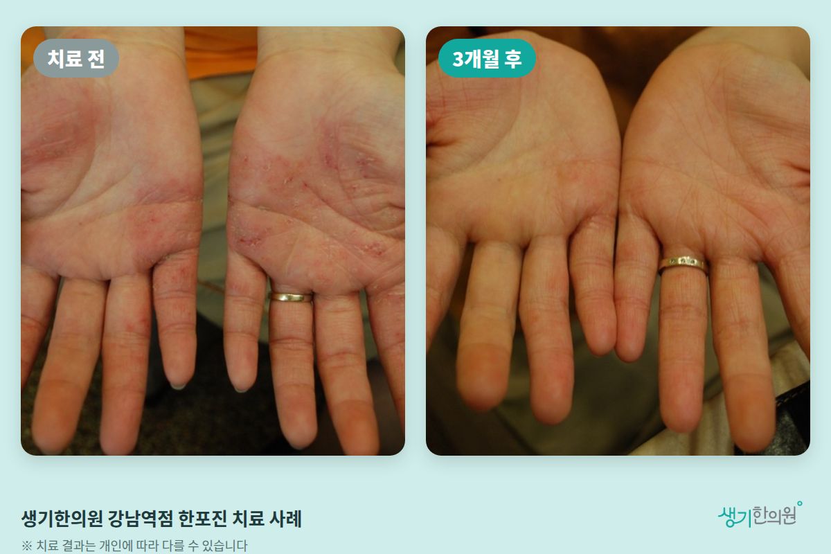 생기한의원 강남역점 한포진 치료 전과 3개월 후 비교 사진