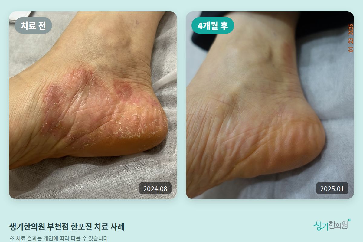 생기한의원 부천점 한포진 치료 전(2024.08)과 4개월 후(2025.01) 비교 사진