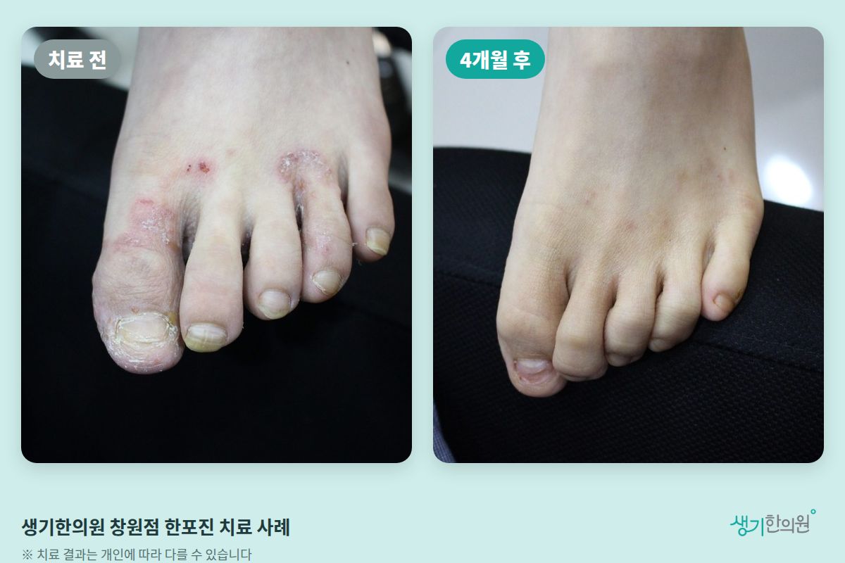 생기한의원 창원점 한포진 치료 전과 4개월 후 비교 사진