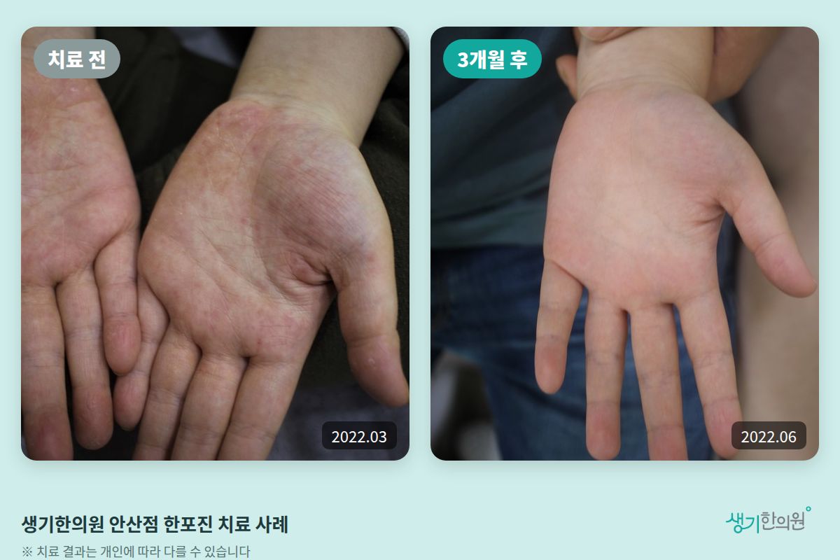 생기한의원 안산점 한포진 치료 전(2022.03)과 3개월 후(2022.06) 비교 사진