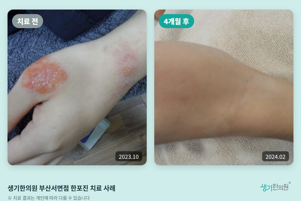 생기한의원 부산서면점 한포진 치료 전(2023.10)과 4개월 후(2024.02) 비교 사진