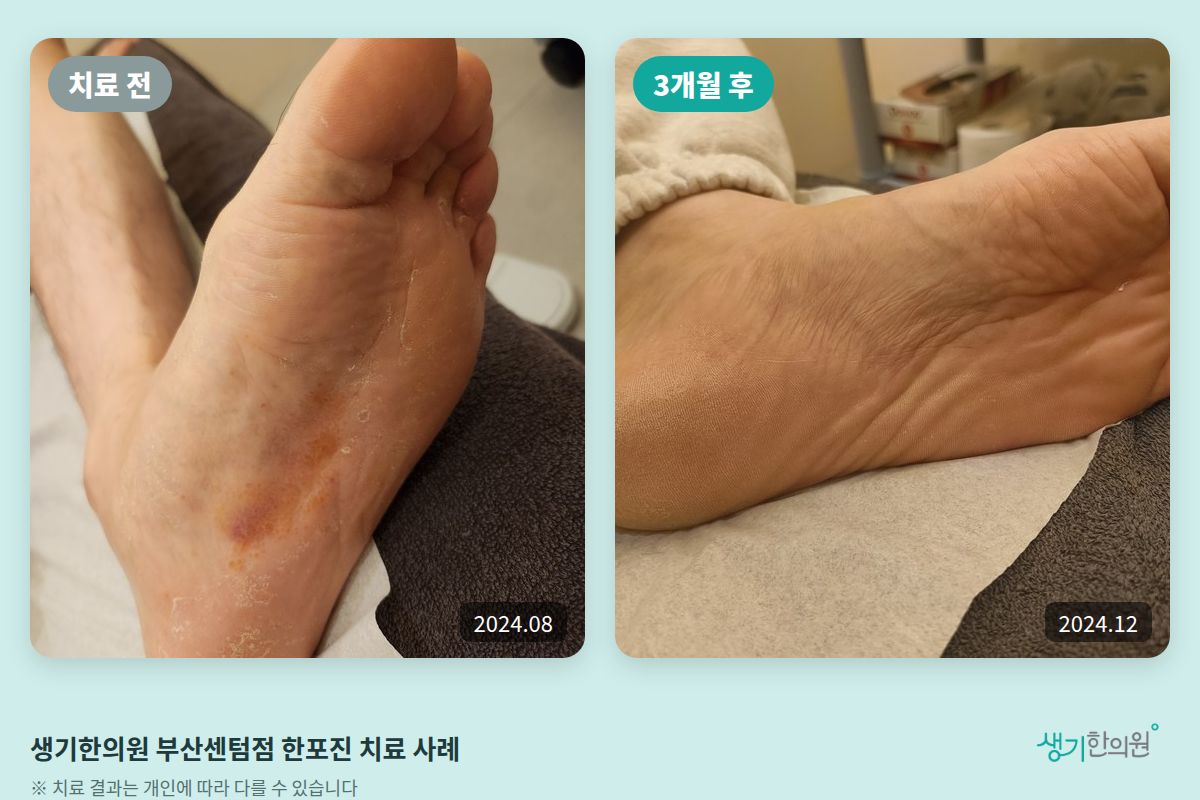 생기한의원 부산센텀점 한포진 치료 전(2024.08)과 3개월 후(2024.12) 비교 사진