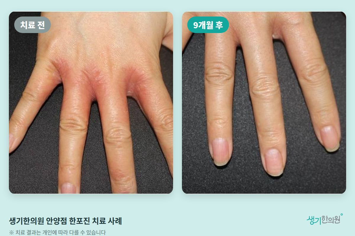생기한의원 안양점 한포진 치료 전과 9개월 후 비교 사진
