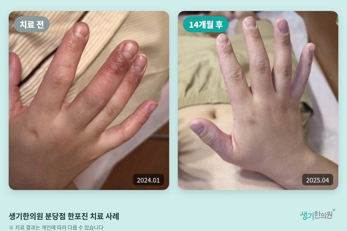 생기한의원 분당점 한포진 치료 전(2024.01)과 14개월 후(2025.04) 비교 사진