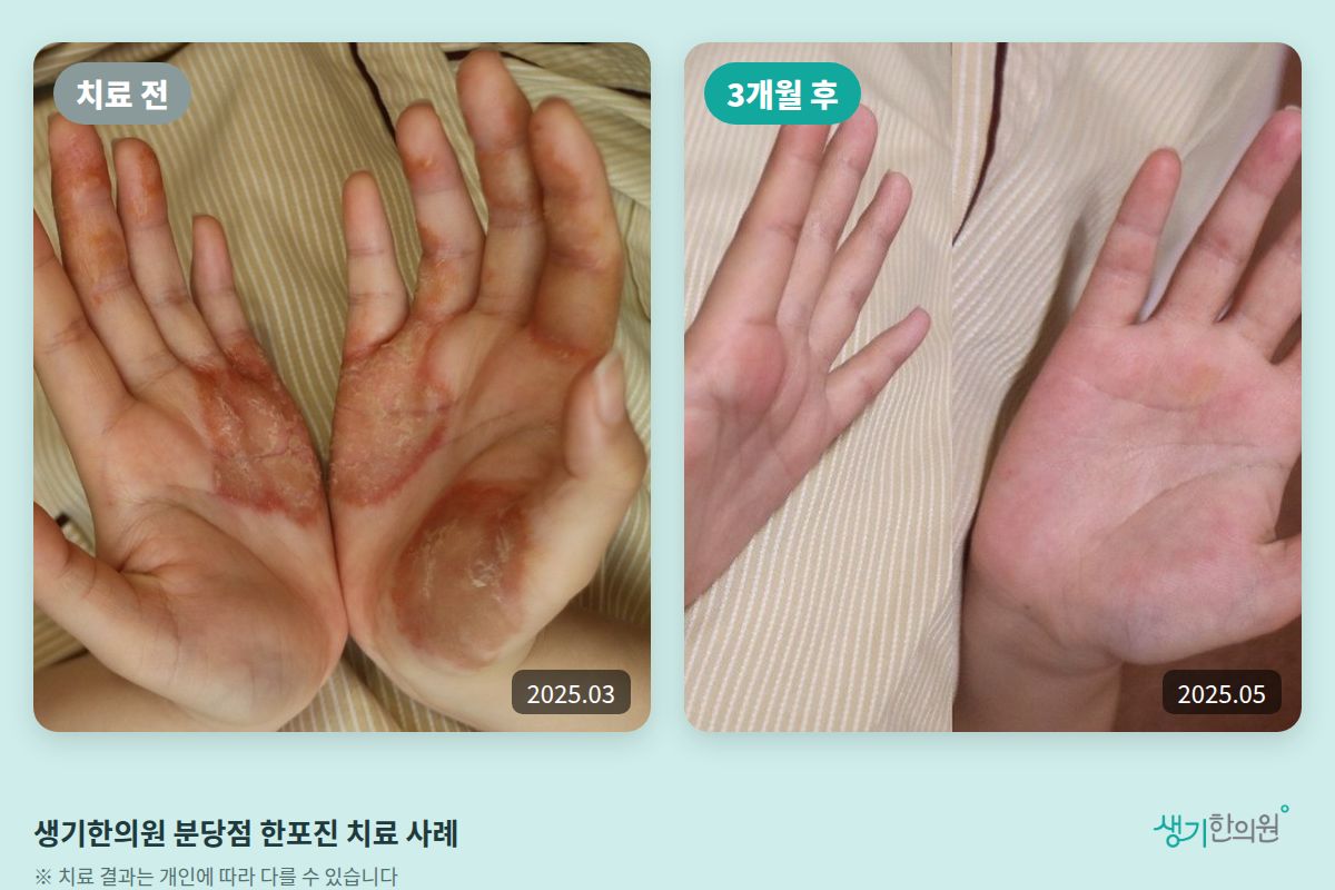 생기한의원 분당점 한포진 치료 전(2025.03)과 3개월 후(2025.05) 손바닥 비교 사진