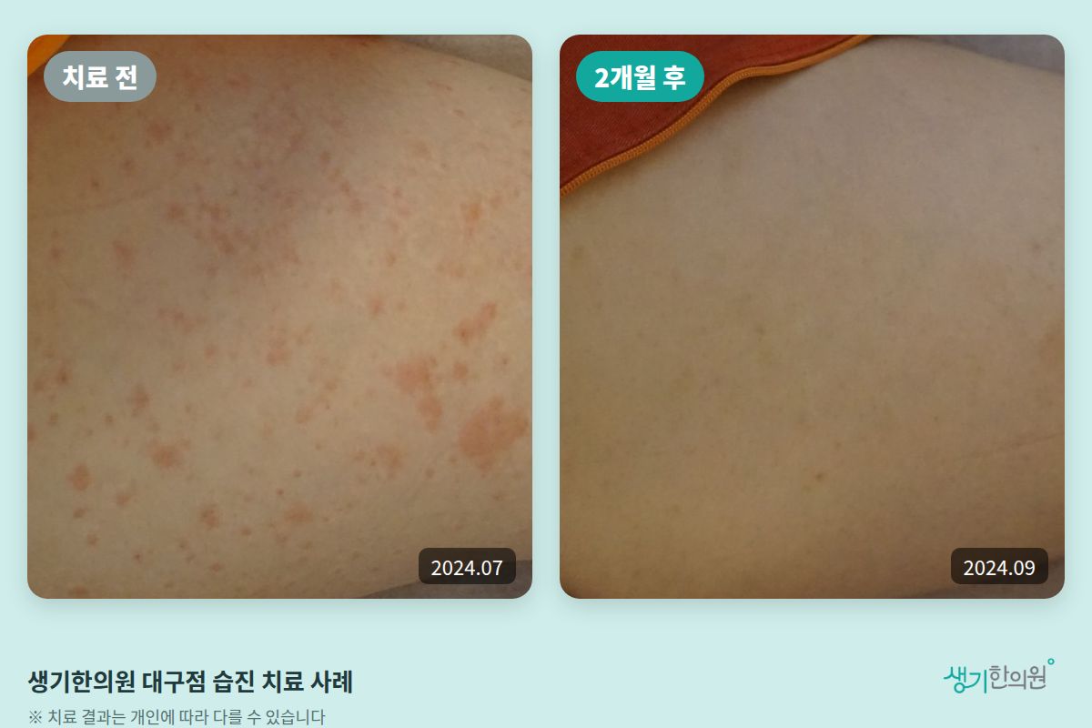 생기한의원 대구점 습진 치료 전(2024.07)과 2개월 후(2024.09) 비교 사진