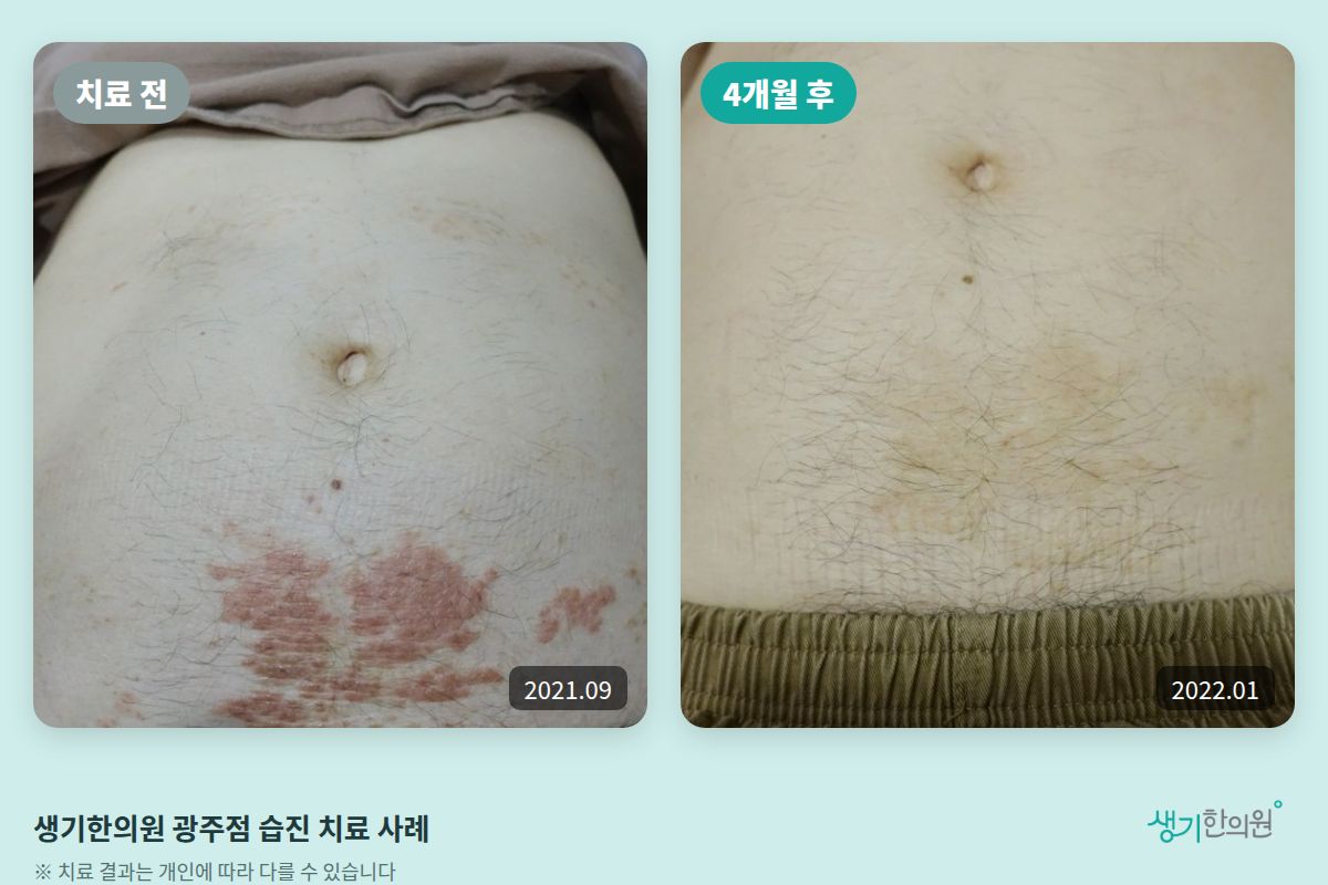 생기한의원 광주점 습진 치료 전(2021.09)과 4개월 후(2022.01) 비교 사진