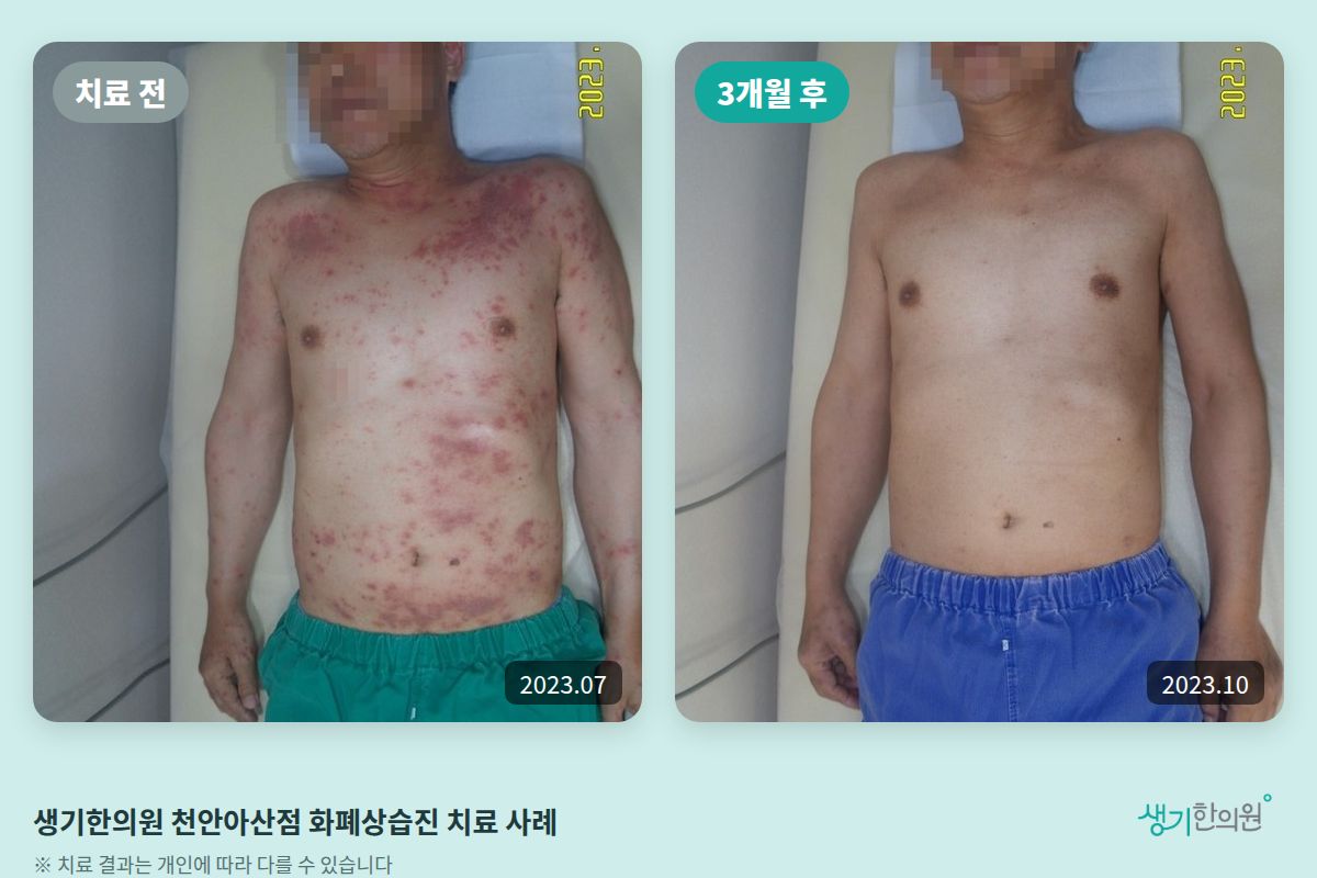 생기한의원 천안아산점 화폐상습진 치료 전(2023.07)과 3개월 후(2023.10) 비교 사진