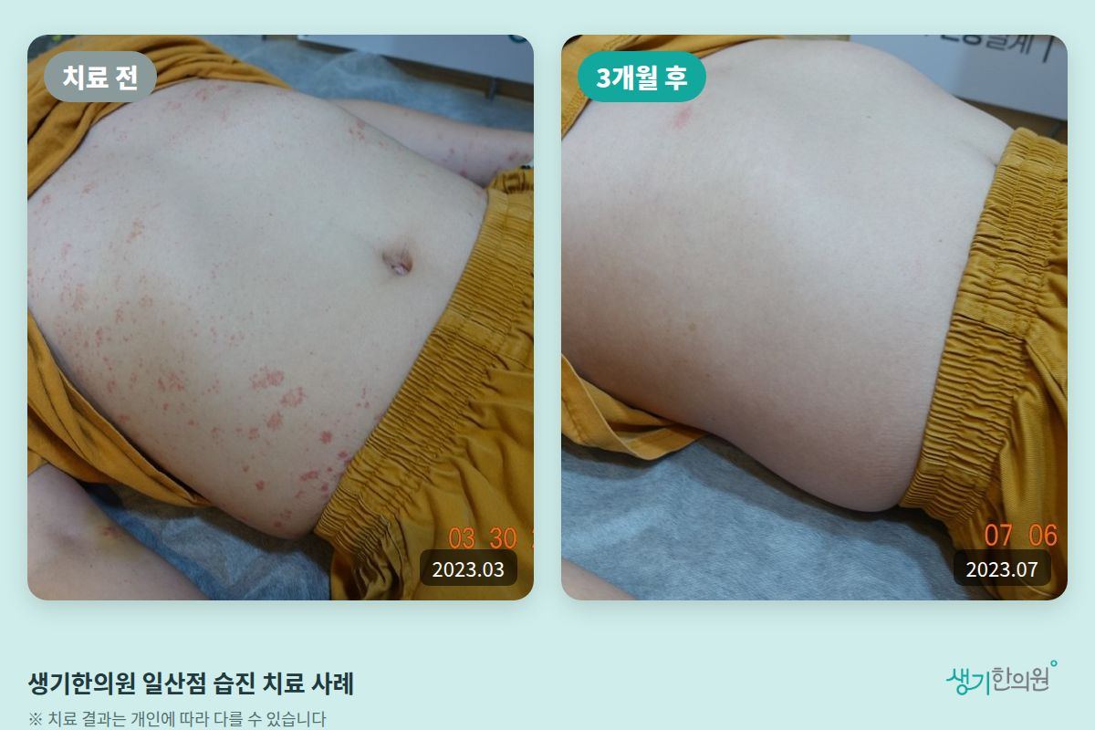 생기한의원 일산점 습진 치료 전(2023.03)과 3개월 후(2023.07) 비교 사진