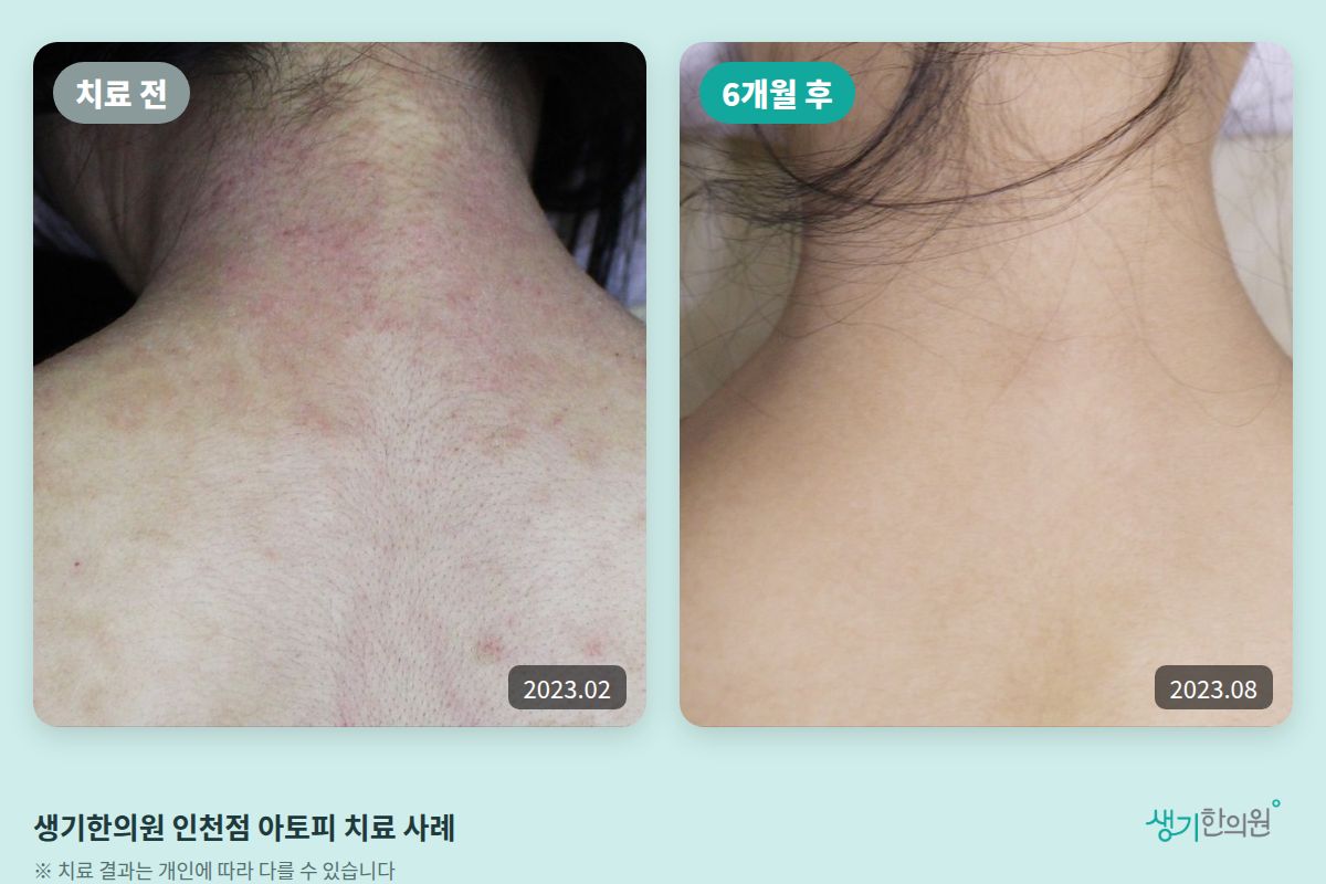 생기한의원 인천점 아토피 치료 전(2023.02)과 6개월 후(2023.08) 비교 사진