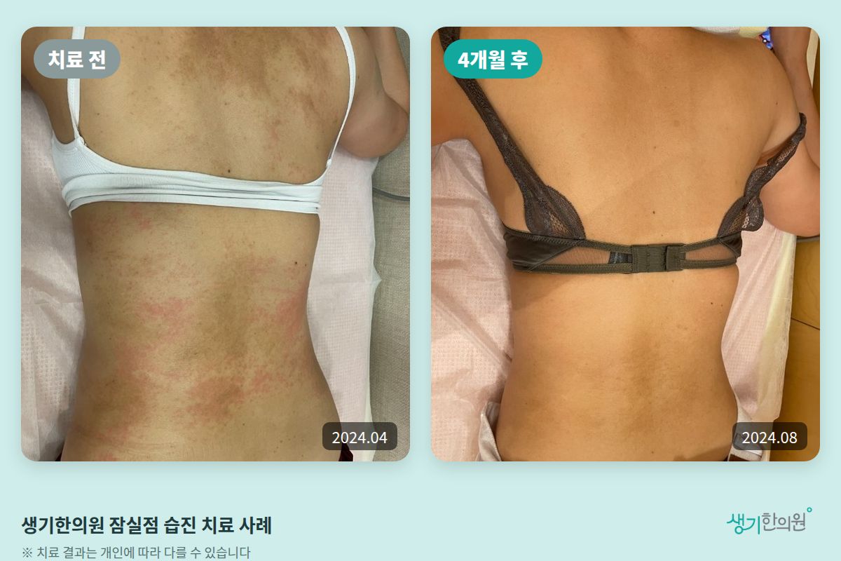 생기한의원 잠실점 습진 치료 전(2024.04)과 4개월 후(2024.08) 비교 사진