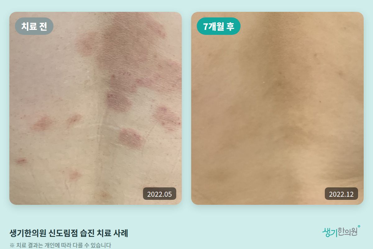 생기한의원 신도림점 습진 치료 전(2022.05)과 7개월 후(2022.12) 비교 사진