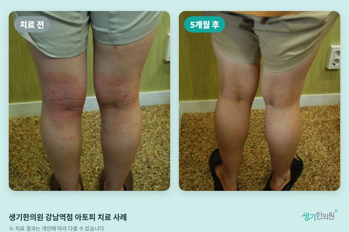 생기한의원 강남역점 아토피 치료 전과 5개월 후 비교 사진