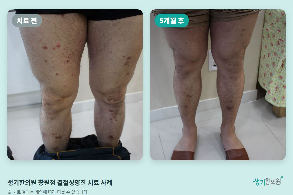 생기한의원 창원점 결절성양진 치료 전과 5개월 후 비교 사진