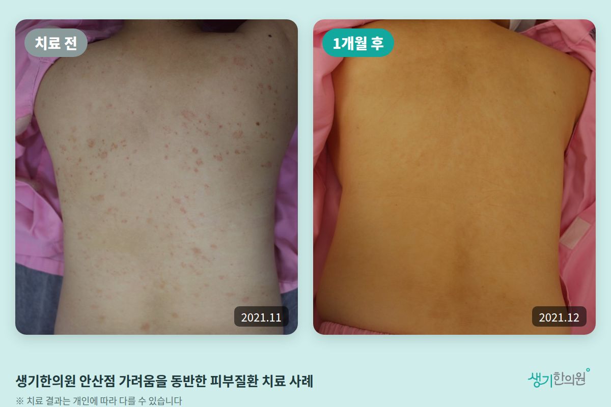생기한의원 안산점 가려움을 동반한 피부질환 치료 전(2021.11)과 1개월 후(2021.12) 비교 사진