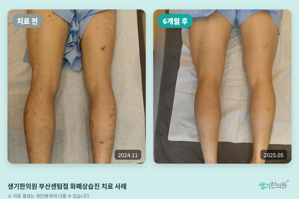 생기한의원 부산센텀점 화폐상습진 치료 전(2024.11)과 6개월 후(2025.05) 비교 사진