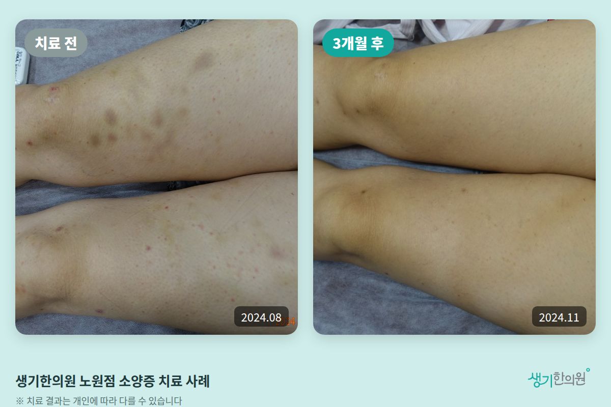 생기한의원 노원점 소양증 치료 전(2024.08)과 3개월 후(2024.11) 비교 사진