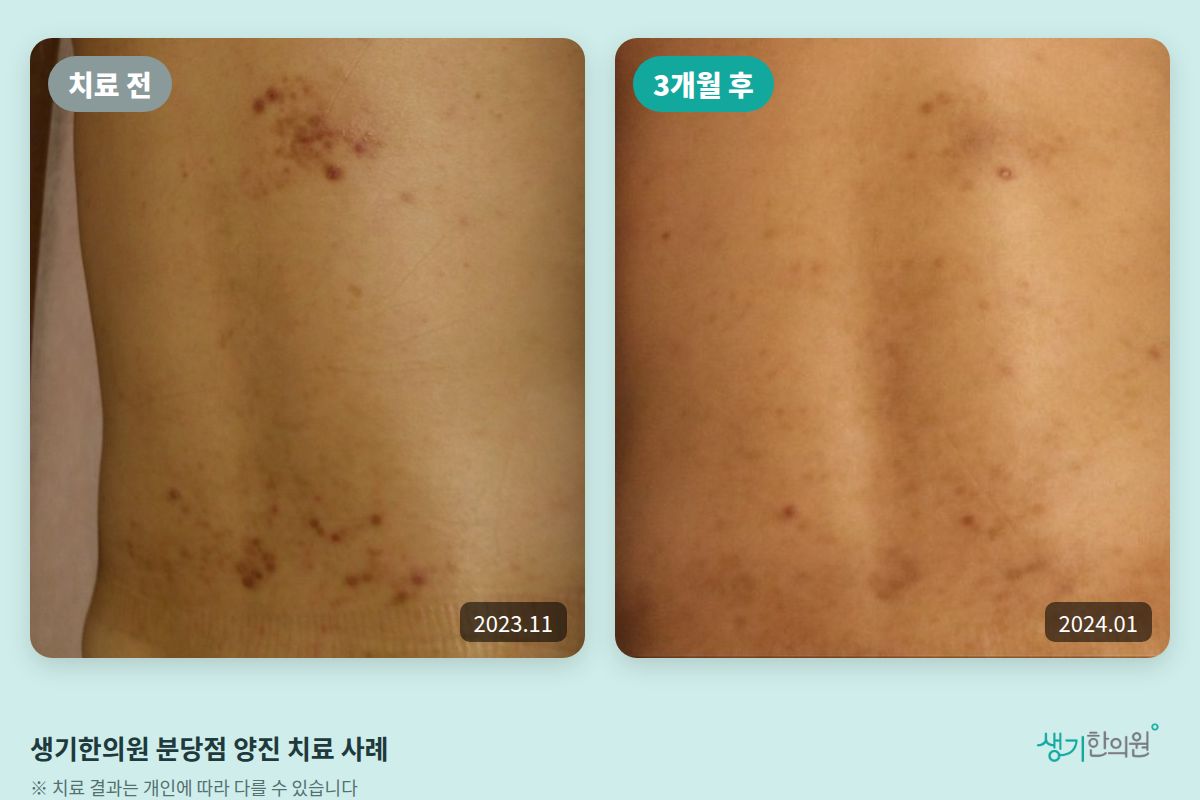 생기한의원 분당점 양진 치료 전(2023.11)과 3개월 후(2024.01) 비교 사진