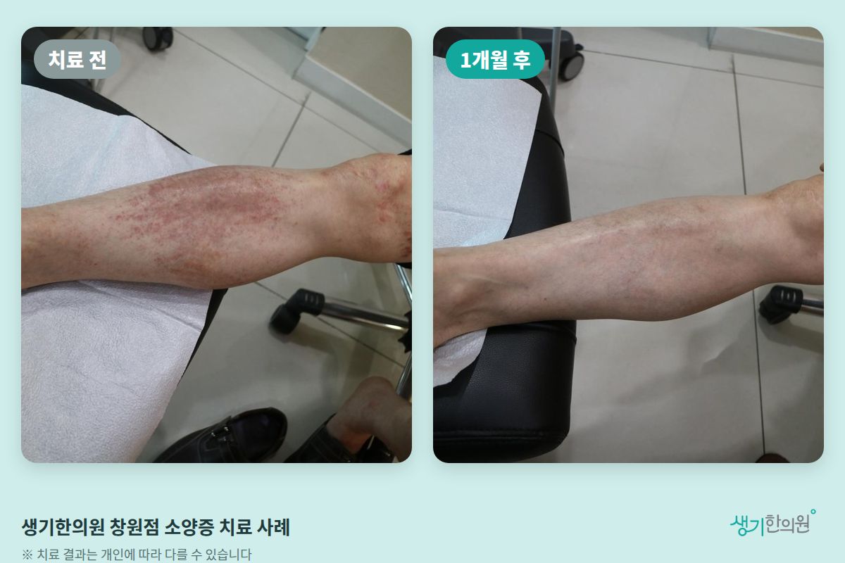 생기한의원 창원점 소양증 치료 전과 1개월 후 팔 비교 사진