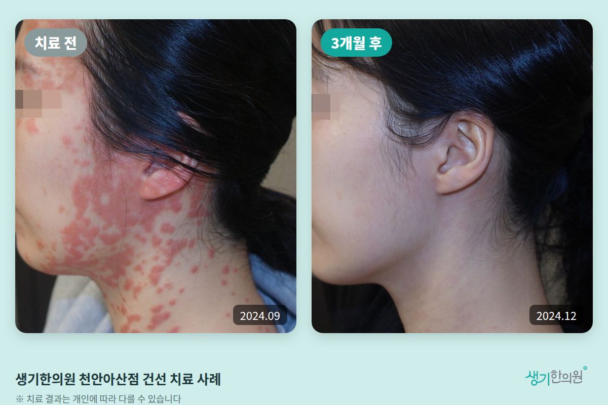 생기한의원 천안아산점 건선 치료 전(2024.09)과 3개월 후(2024.12) 비교 사진