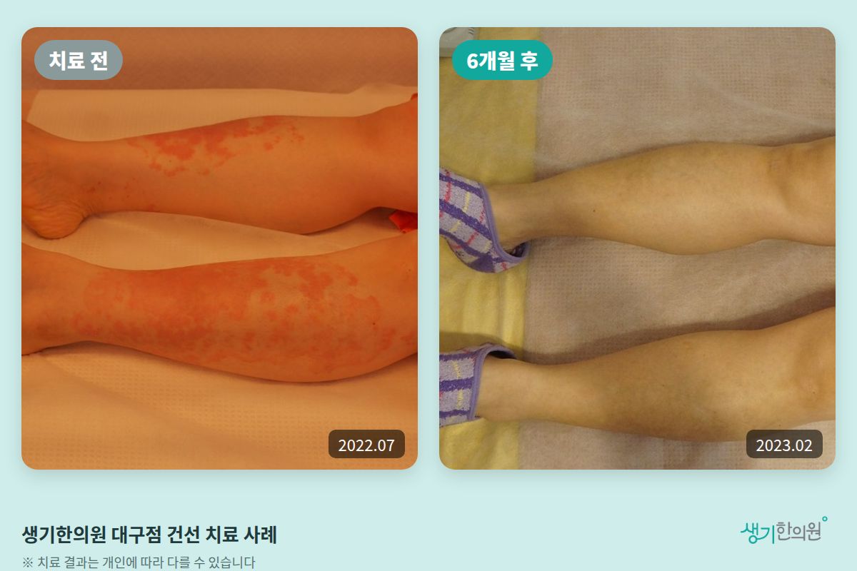 생기한의원 대구점 건선 치료 전(2022.07)과 6개월 후(2023.02) 비교 사진