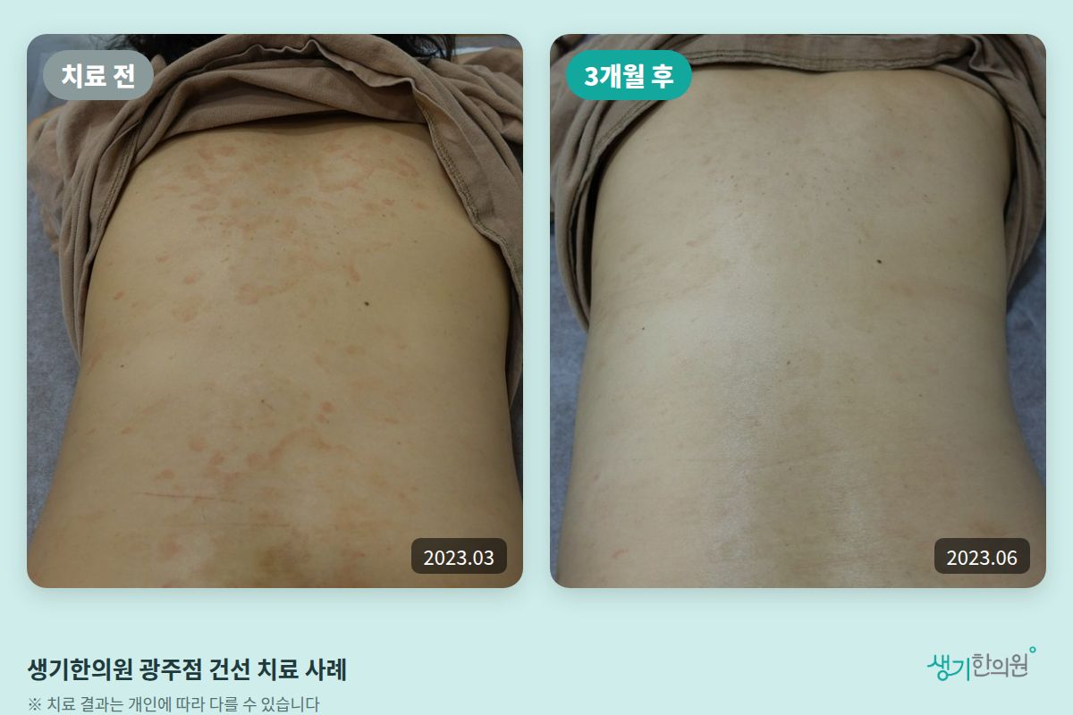 생기한의원 광주점 건선 치료 전(2023.03)과 3개월 후(2023.06) 비교 사진