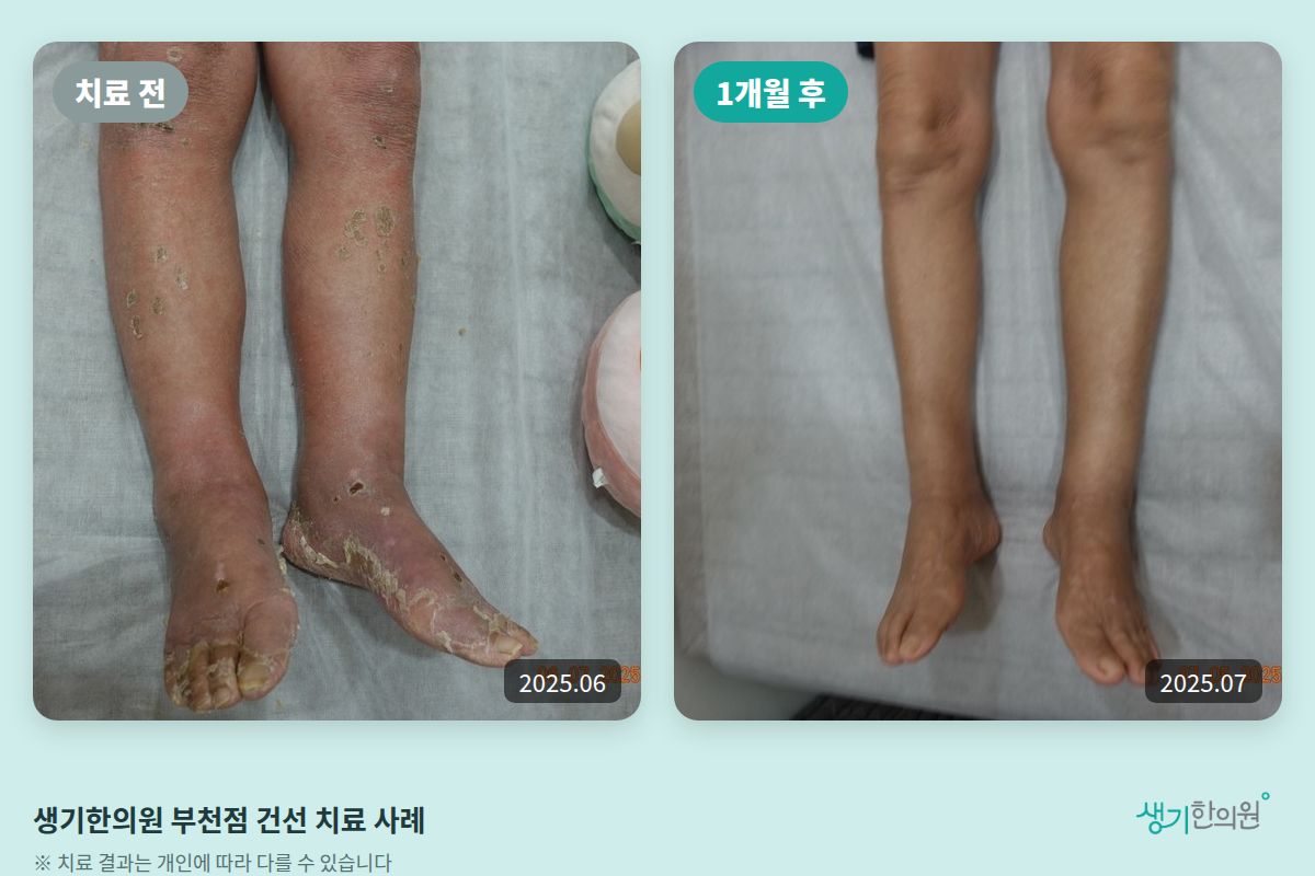 생기한의원 부천점 건선 치료 전(2025.06)과 1개월 후(2025.07) 비교 사진