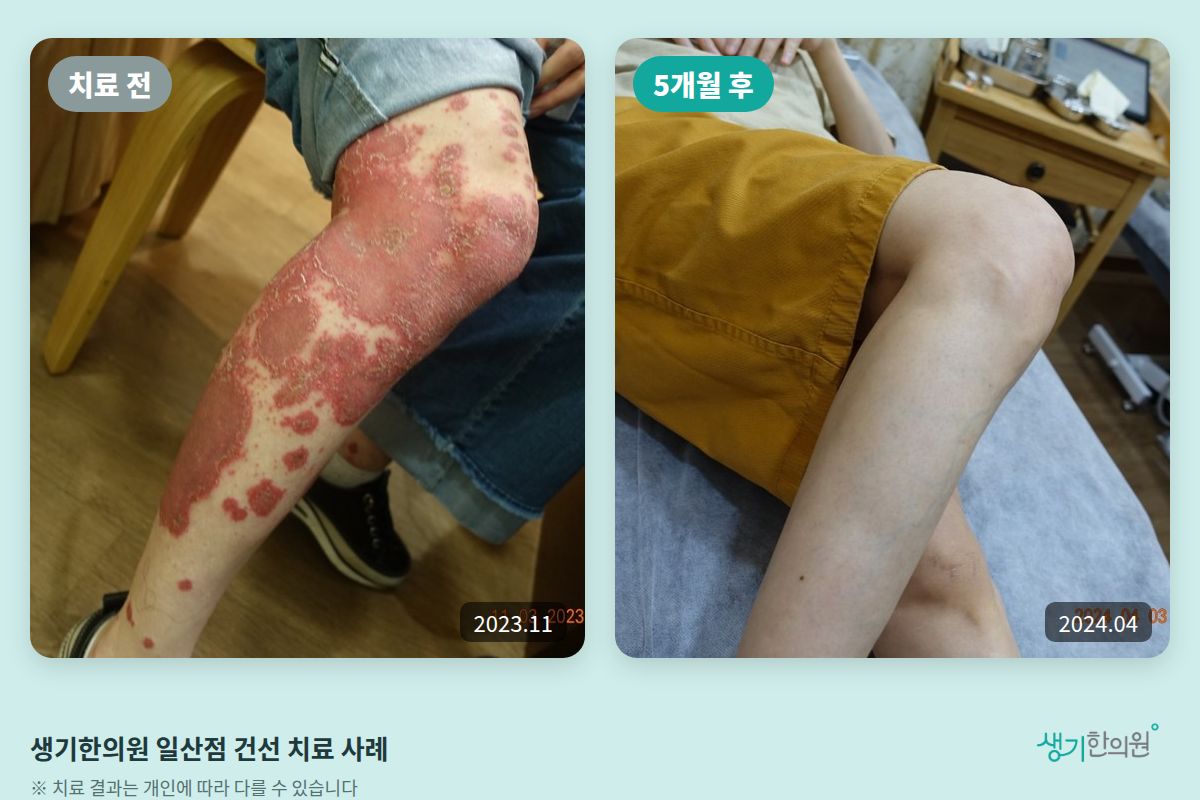 생기한의원 일산점 건선 치료 전(2023.11)과 5개월 후(2024.04) 비교 사진