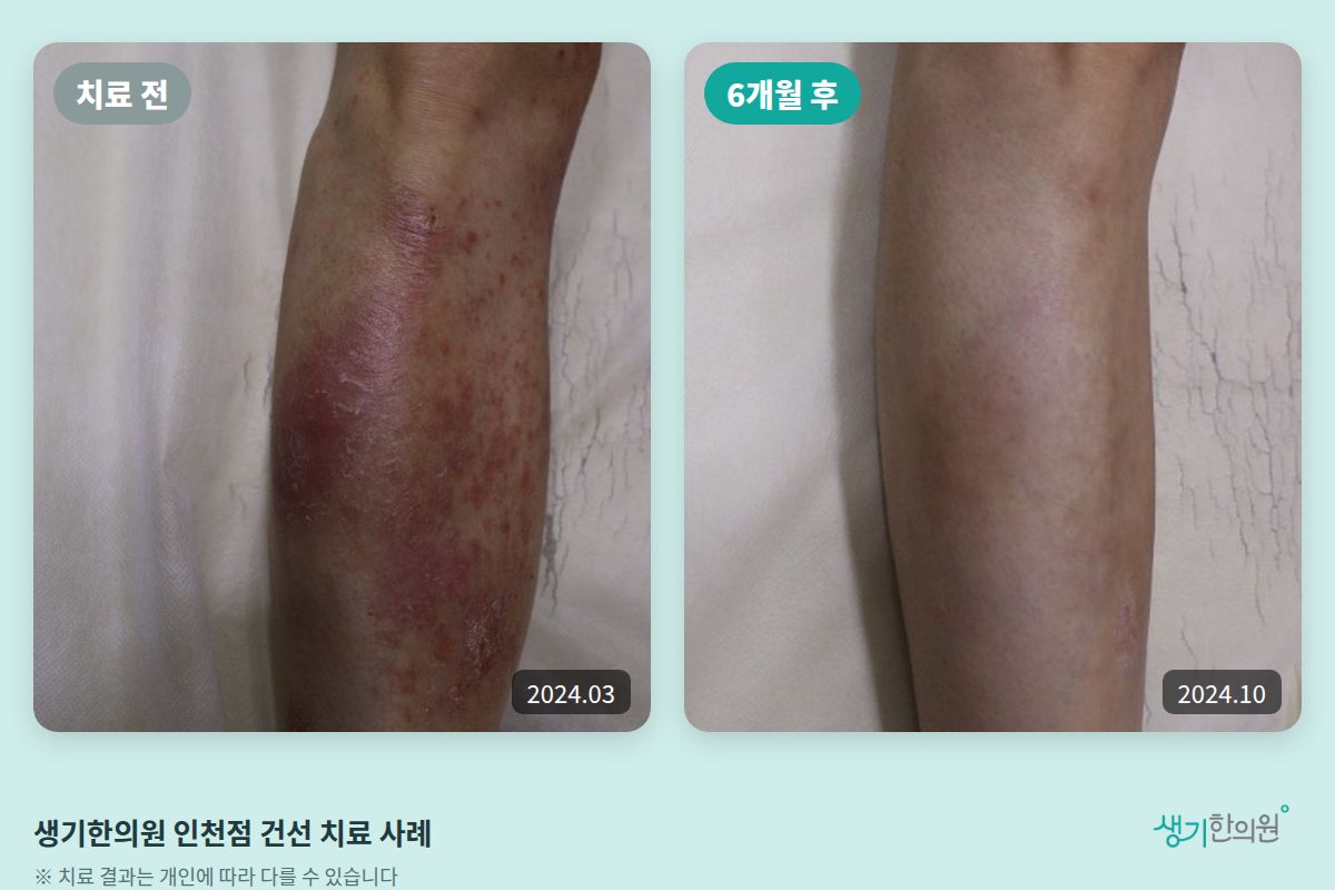 생기한의원 인천점 건선 치료 전(2024.03)과 6개월 후(2024.10) 비교 사진