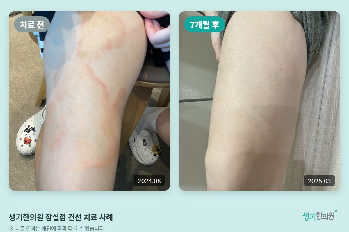 생기한의원 잠실점 건선 치료 전(2024.08)과 7개월 후(2025.03) 비교 사진
