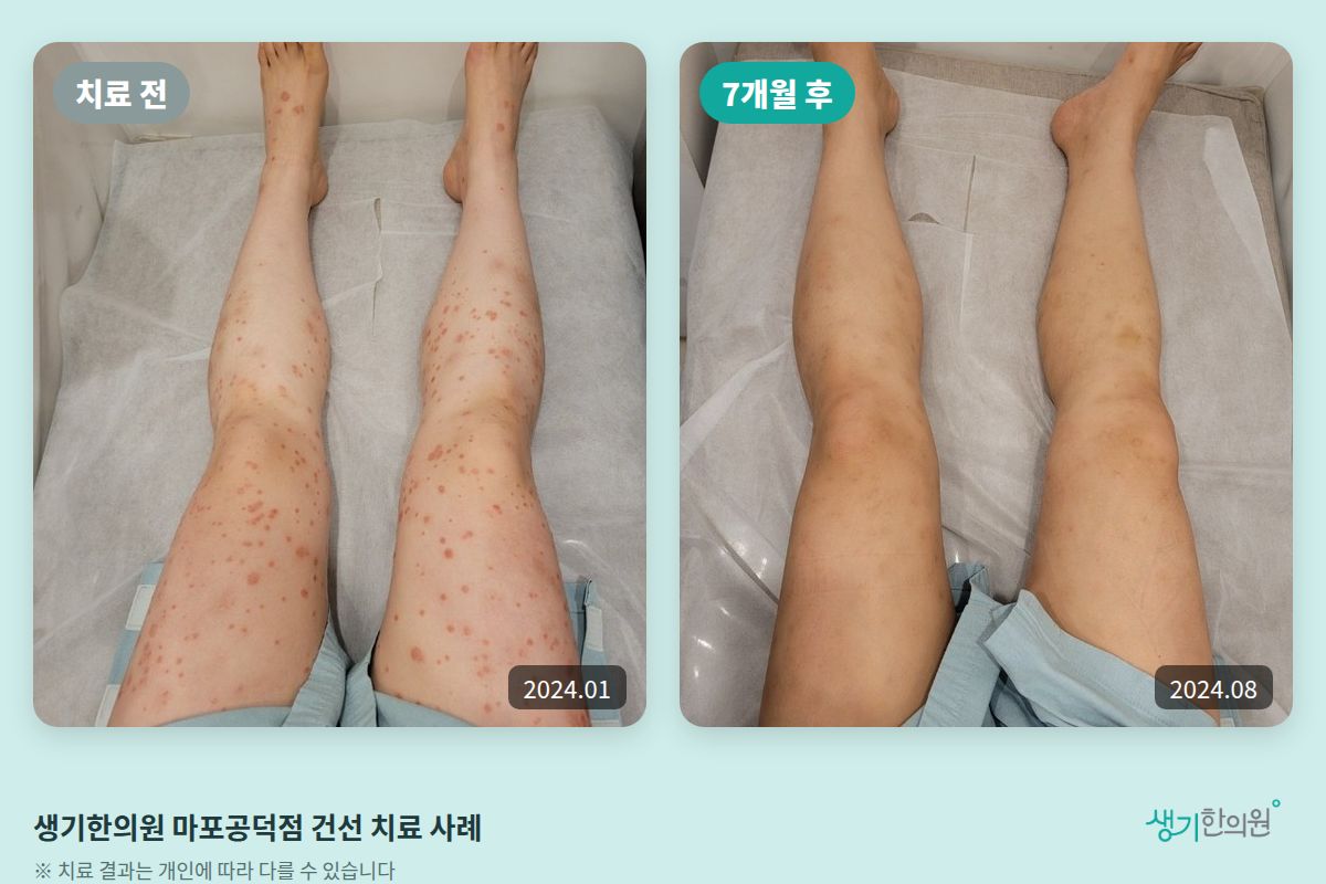 생기한의원 마포공덕점 건선 치료 전(2024.01)과 7개월 후(2024.08) 비교 사진