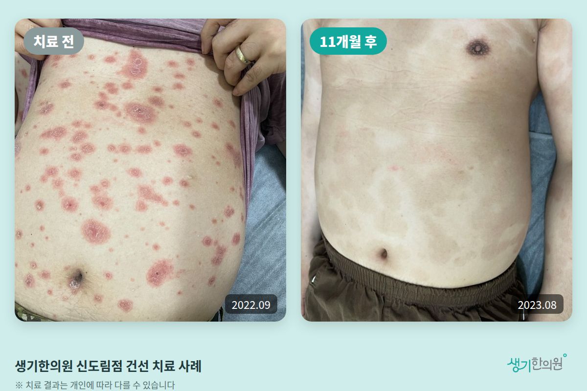 생기한의원 신도림점 건선 치료 전(2022.09)과 11개월 후(2023.08) 비교 사진