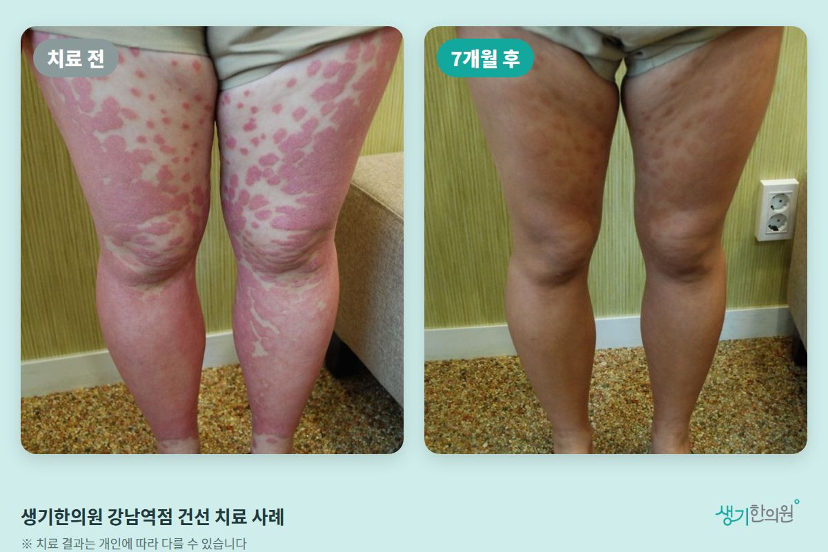 생기한의원 강남역점 건선 치료 전과 7개월 후 비교 사진