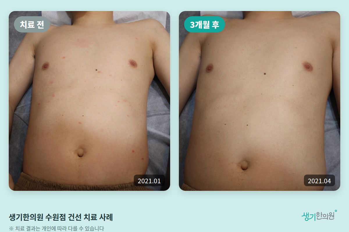 생기한의원 수원점 건선 치료 전(2021.01)과 3개월 후(2021.04) 비교 사진