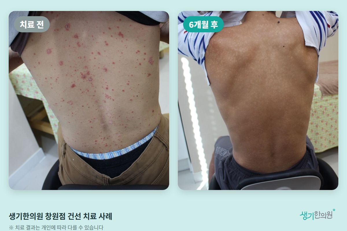 생기한의원 창원점 건선 치료 전과 6개월 후 비교 사진