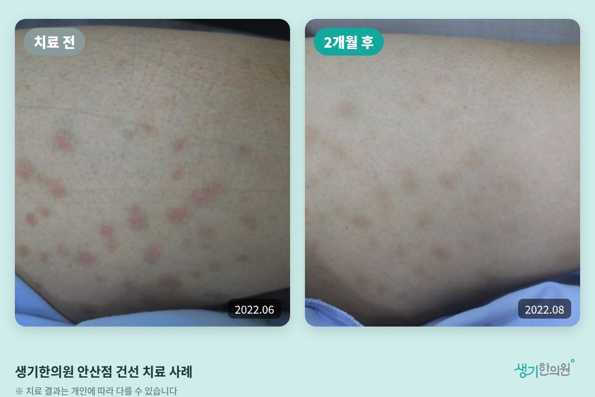 생기한의원 안산점 건선 치료 전(2022.06)과 2개월 후(2022.08) 비교 사진