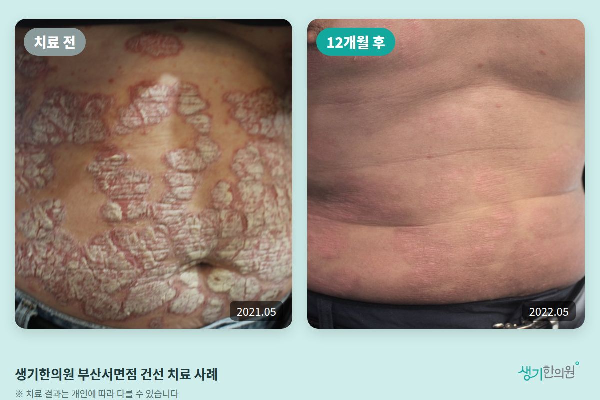 생기한의원 부산서면점 건선 치료 전(2021.05)과 12개월 후(2022.05) 비교 사진