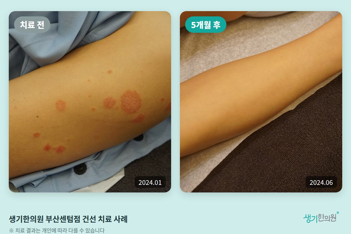 생기한의원 부산센텀점 건선 치료 전(2024.01)과 5개월 후(2024.06) 비교 사진