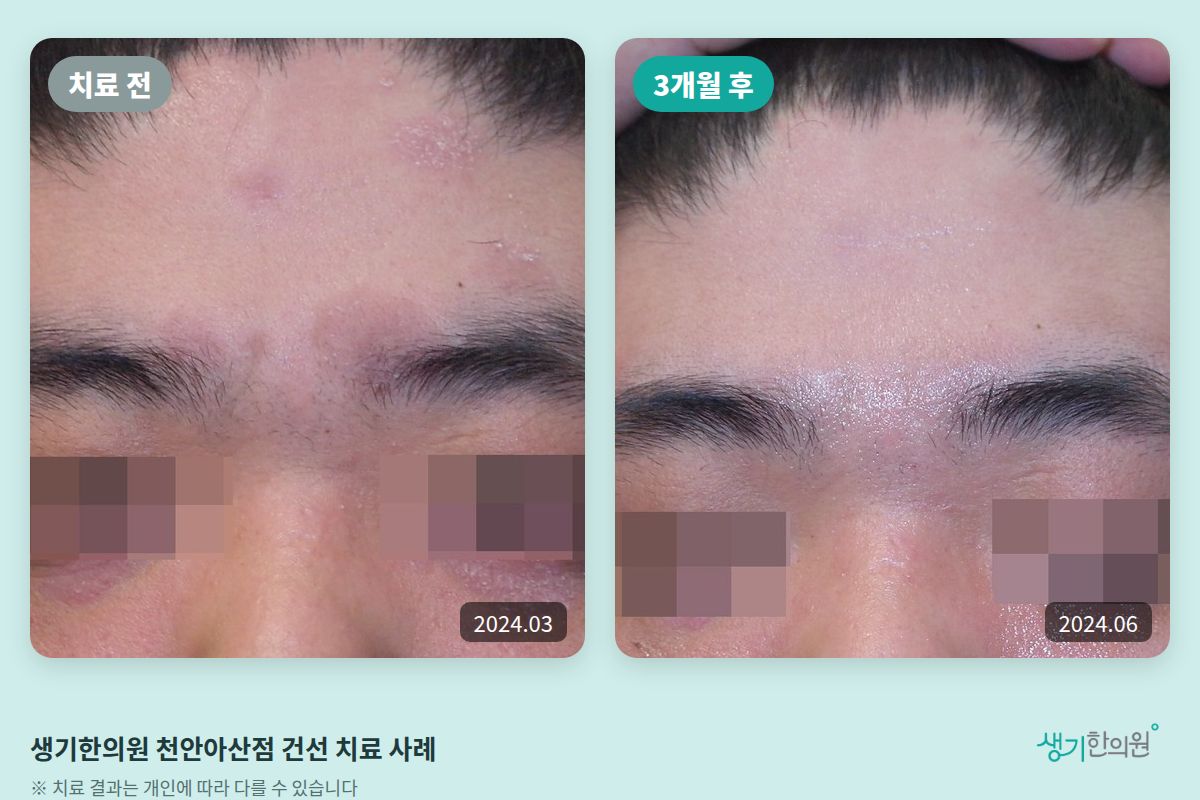 생기한의원 천안아산점 건선 치료 전(2024.03)과 3개월 후(2024.06) 이마 비교 사진