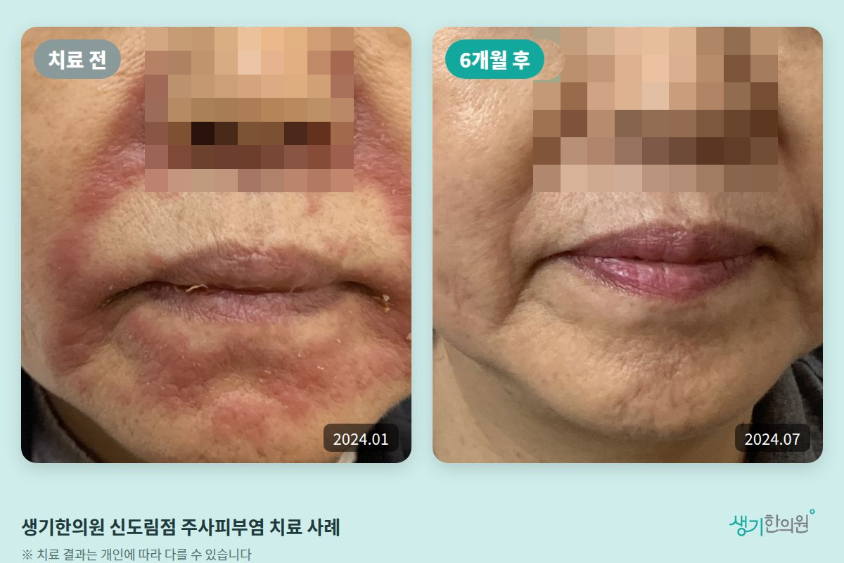 생기한의원 신도림점 주사피부염 치료 전(2024.01)과 6개월 후(2024.07) 비교 사진